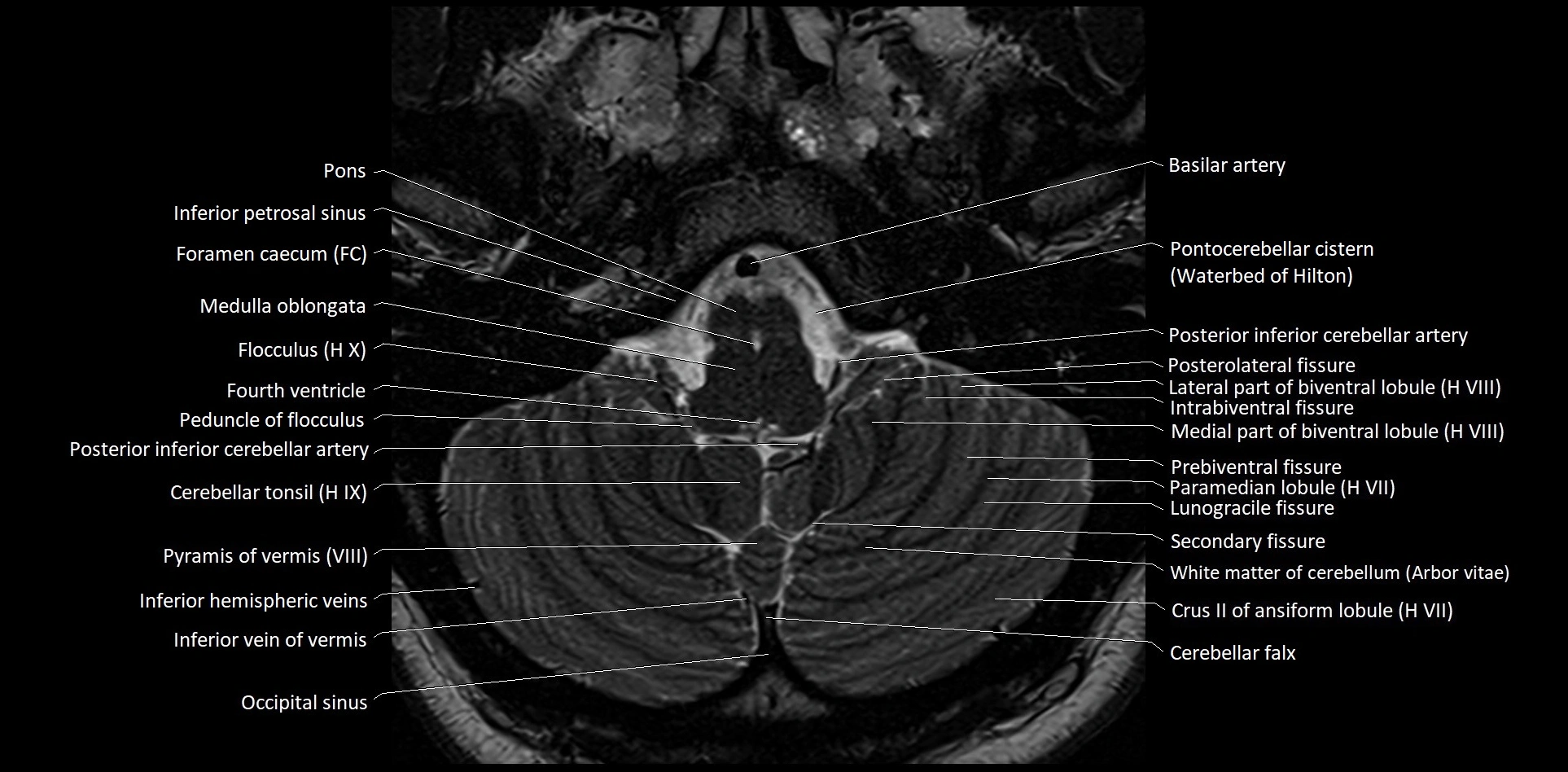 MRI Cerebellar anatomy High-resolution labelled 3T MRI image 8.webp